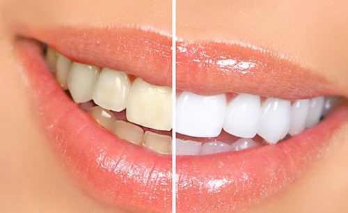 Before and after teeth whitening